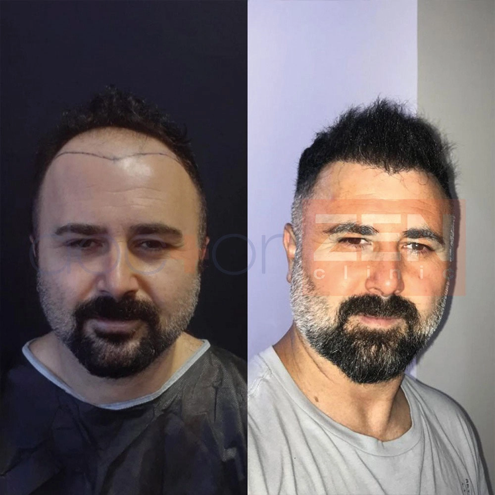 before-after6